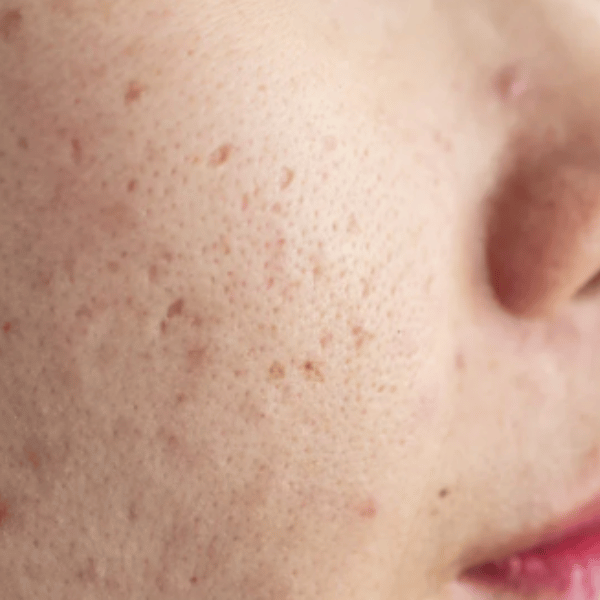 Acne Marks